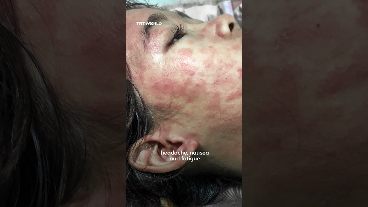Here&rsquo;s what you need to know about the chikungunya virus
