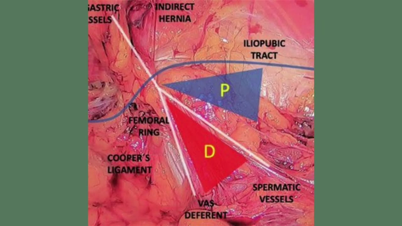 Triangle of doom vs pain: Mnemonic, Contents, Easy Images