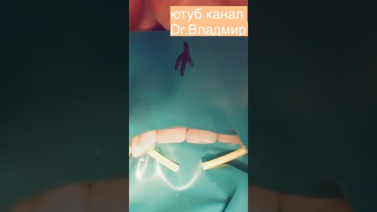 Фиксация платка Раббердам с помощью кордов.#2.#cofferdamrubber #раббердамология