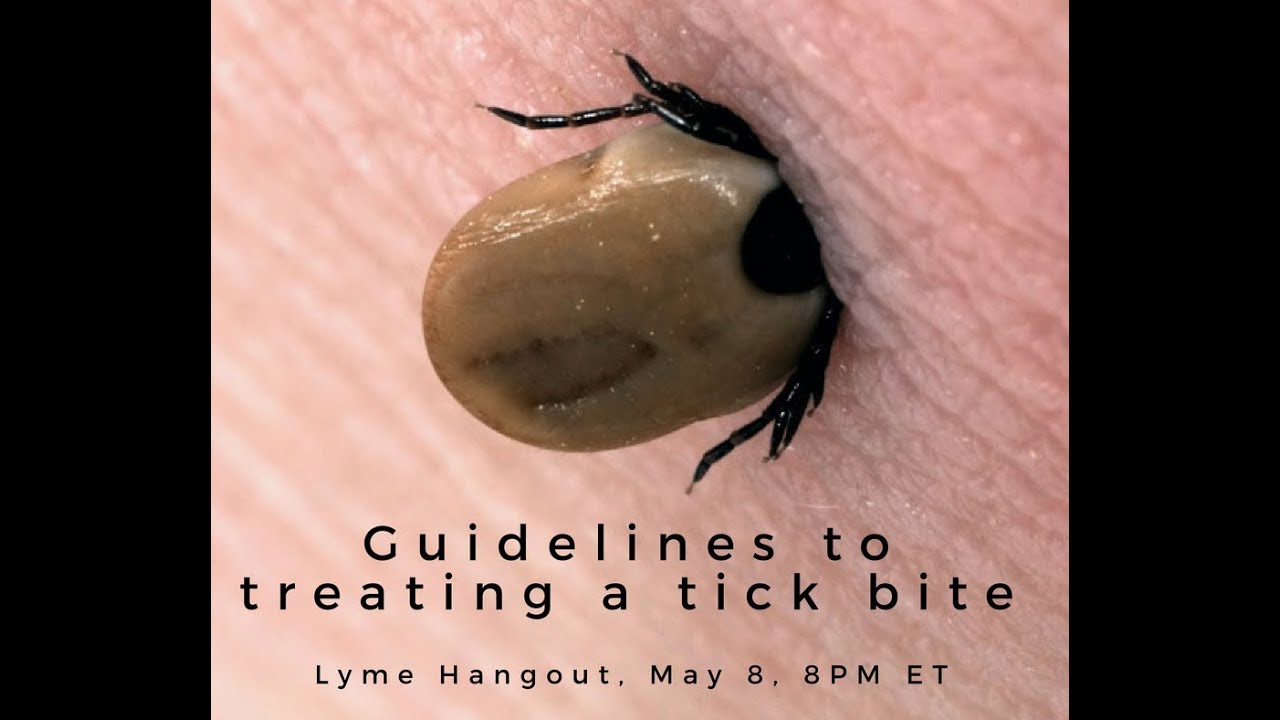 Guidelines to treating a tick bite