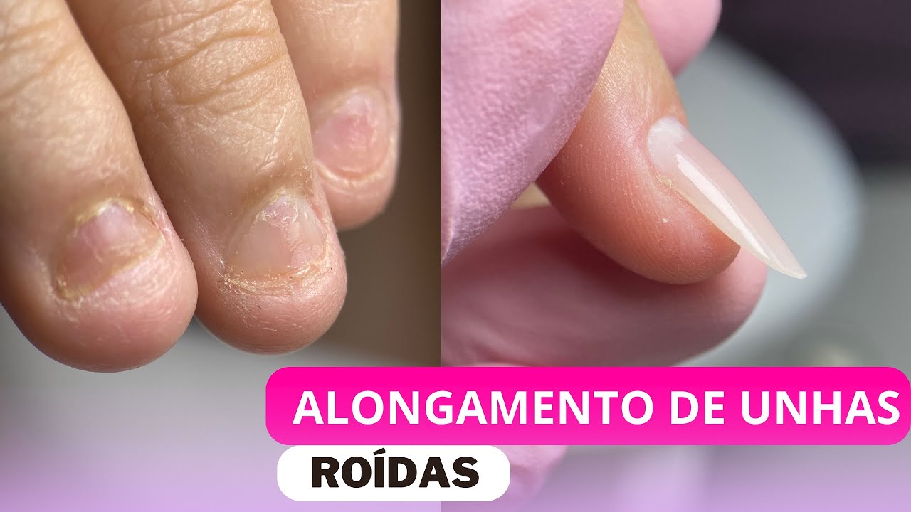 Alongamento de unhas roídas todos os detalhes estão aqui🔥