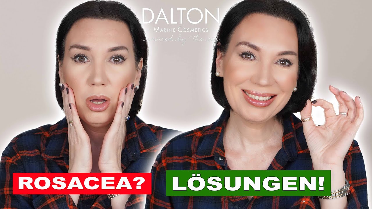 Das hilft dir bei Rosacea und Couperose | DALTON 30% Singlesweek