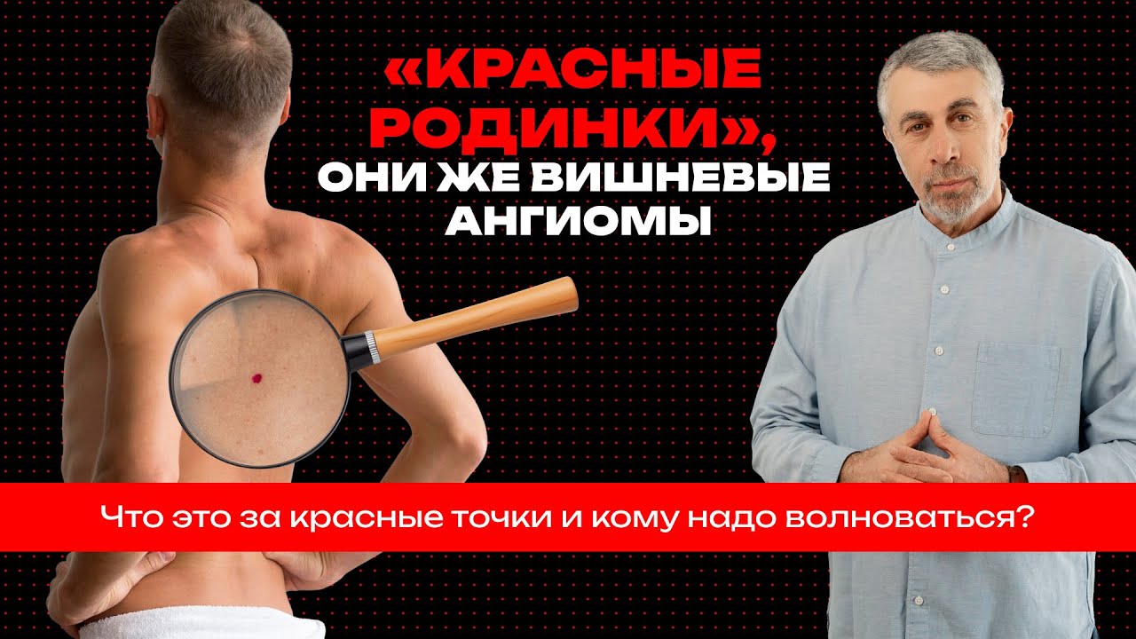 «Красные родинки», они же вишневые ангиомы. Что это за красные точки и кому надо волноваться?