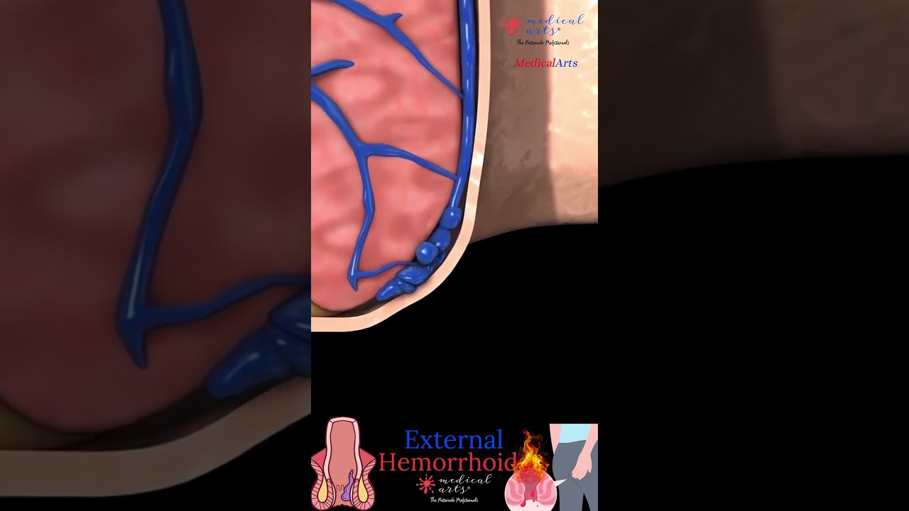 What do hemorrhoids look like?
