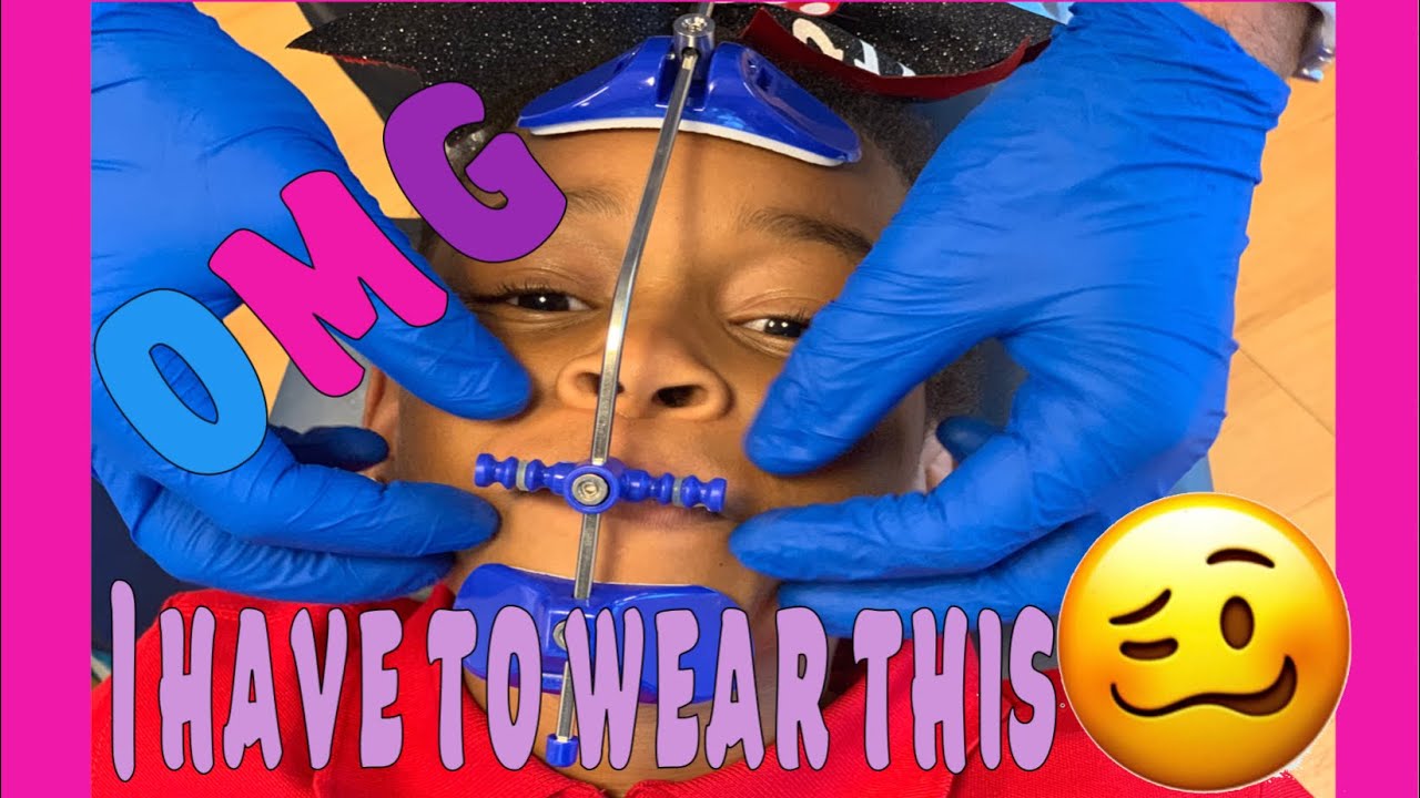 Follow My Orthodontics Journey | Ortho Vlog | Ep 2. Orthodontic Facemask