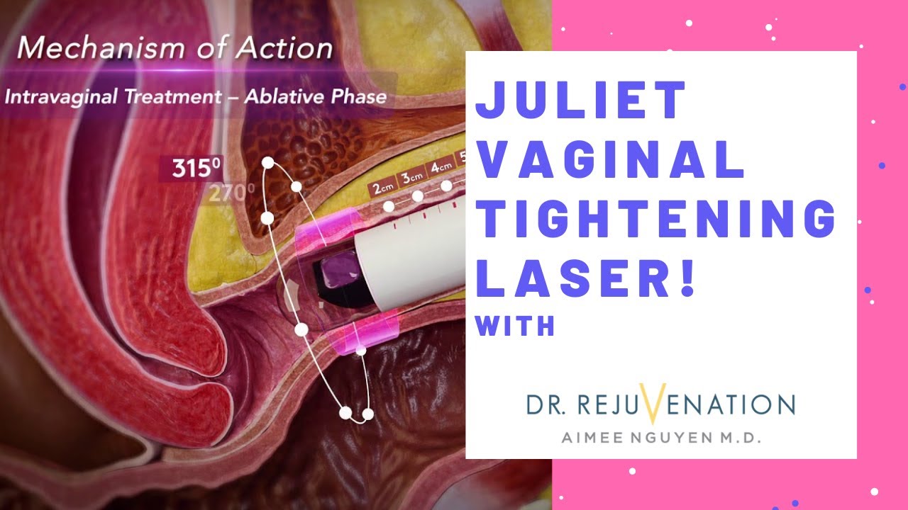 Juliet Vaginal Tightening Laser! -  Girl Talk with Dr. Rejuvenation