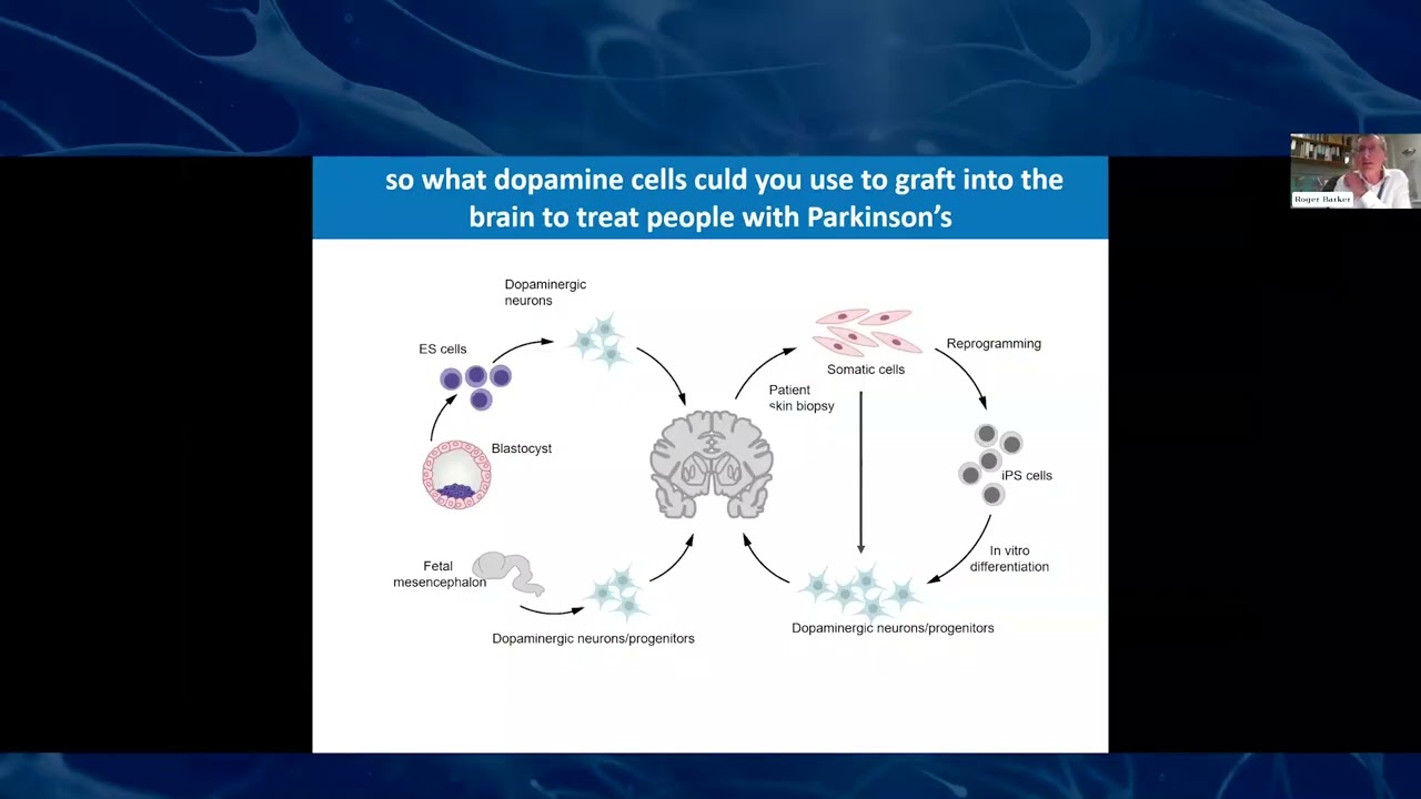 Stem Cells and Parkinson’s Disease  Research Advances + Patient Experiences