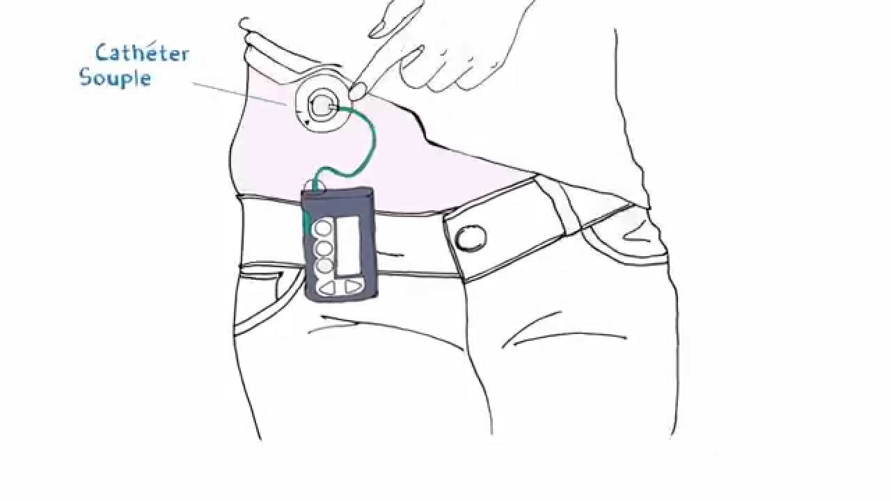 La pompe à insuline