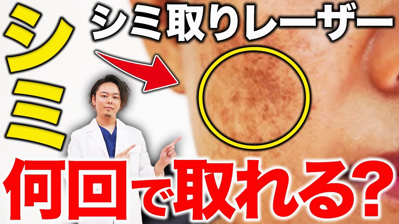 シミ取りのレーザーは何回で綺麗になる？医師が教えるシミを消す方法
