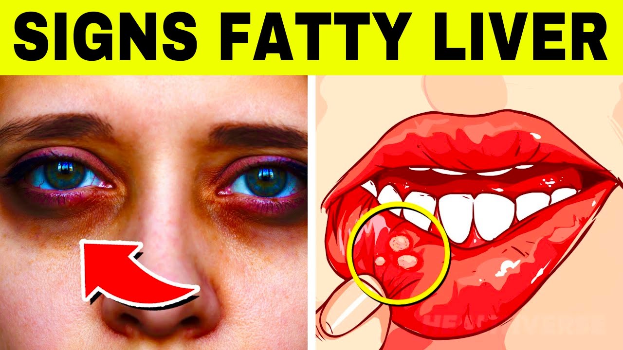 9 Common and Ignored Signs of FATTY LIVER (Hepatic Steatosis)