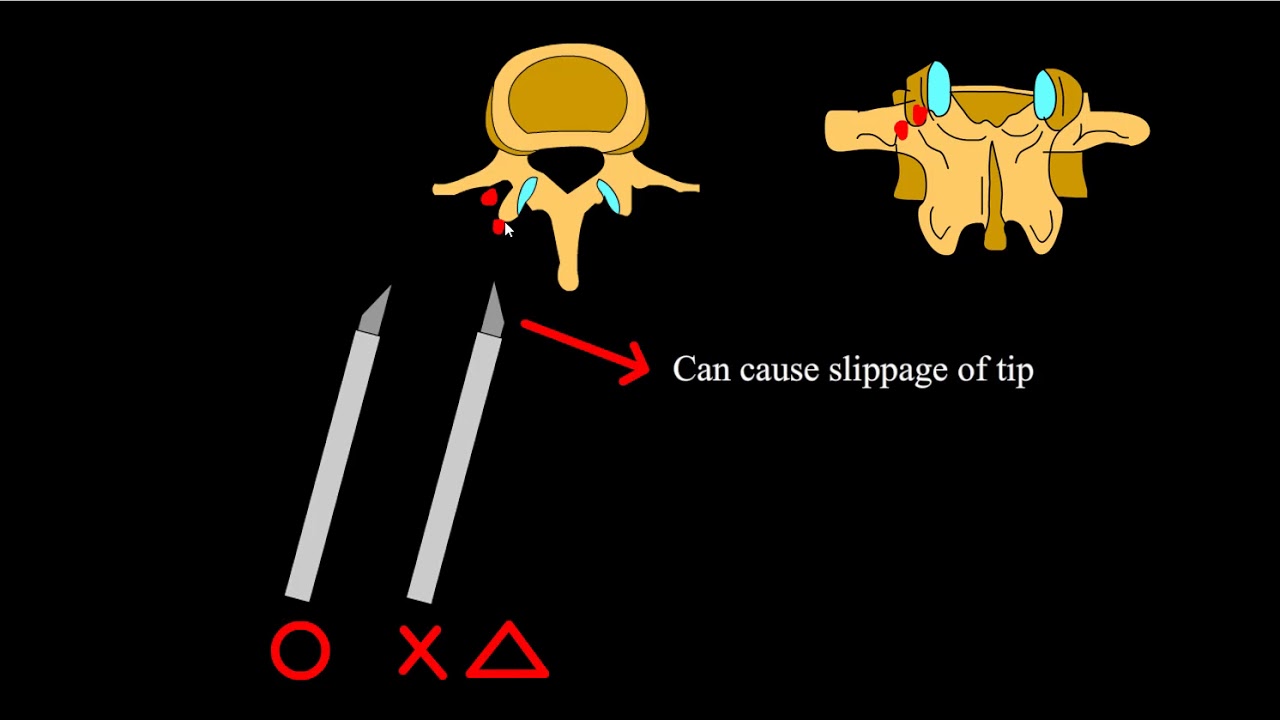 vertebroplasty, direction of bevel of needle