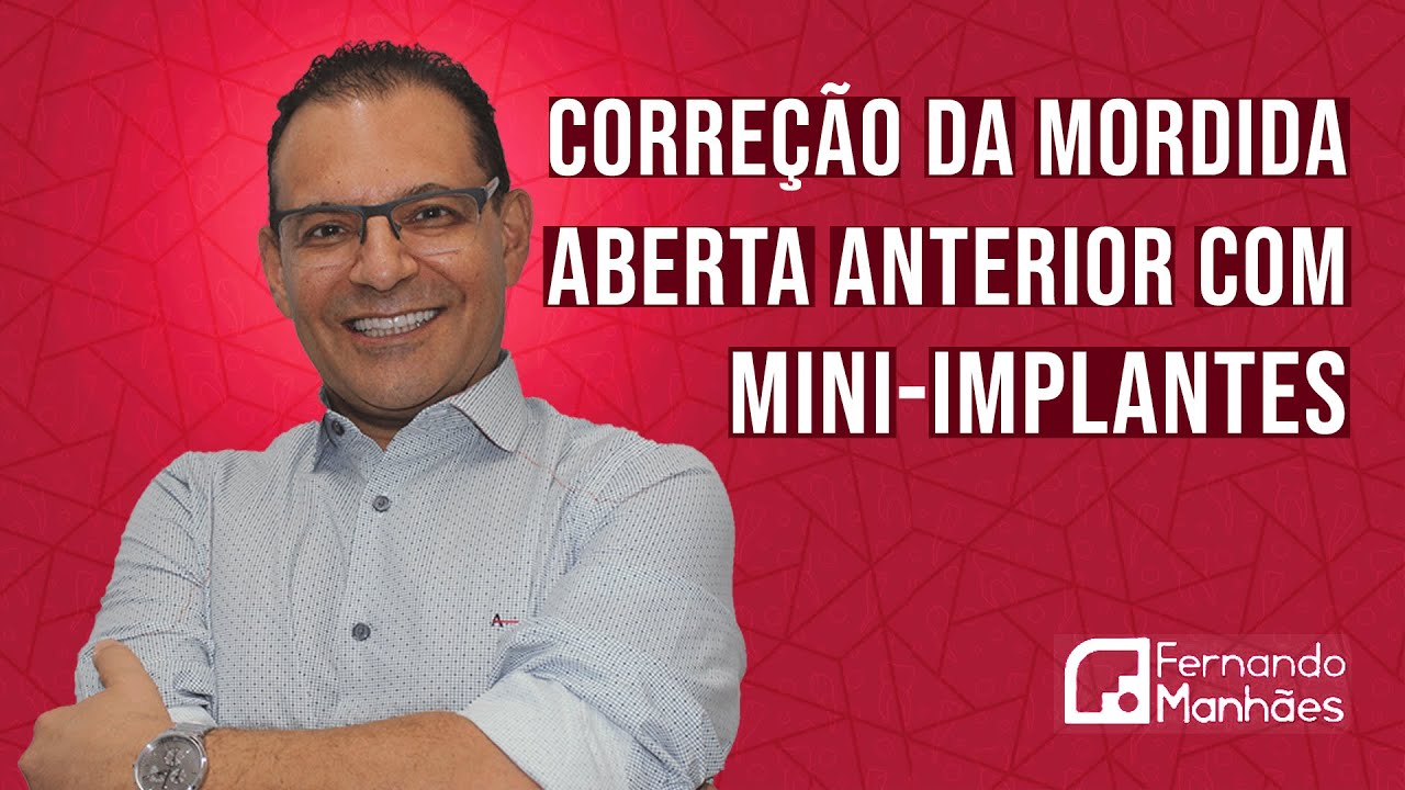CORREÇÃO DA MORDIDA ABERTA ANTERIOR COM MINI-IMPLANTES | FERNANDO MANHÃES