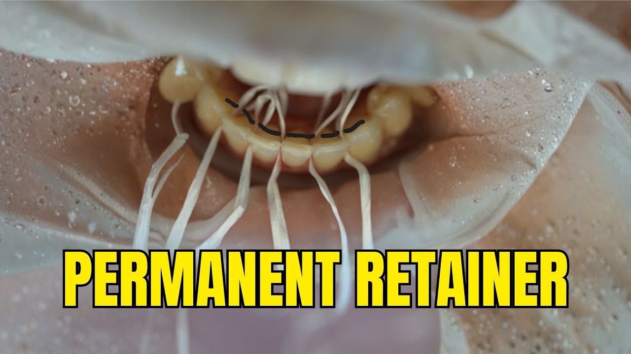 [ASMR] Как закрепить постоянный ретейнер #брекеты #ортодонт