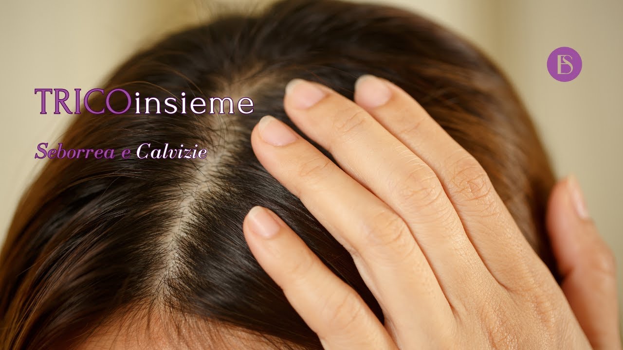 TRICOinsieme: Seborrea e Calvizie
