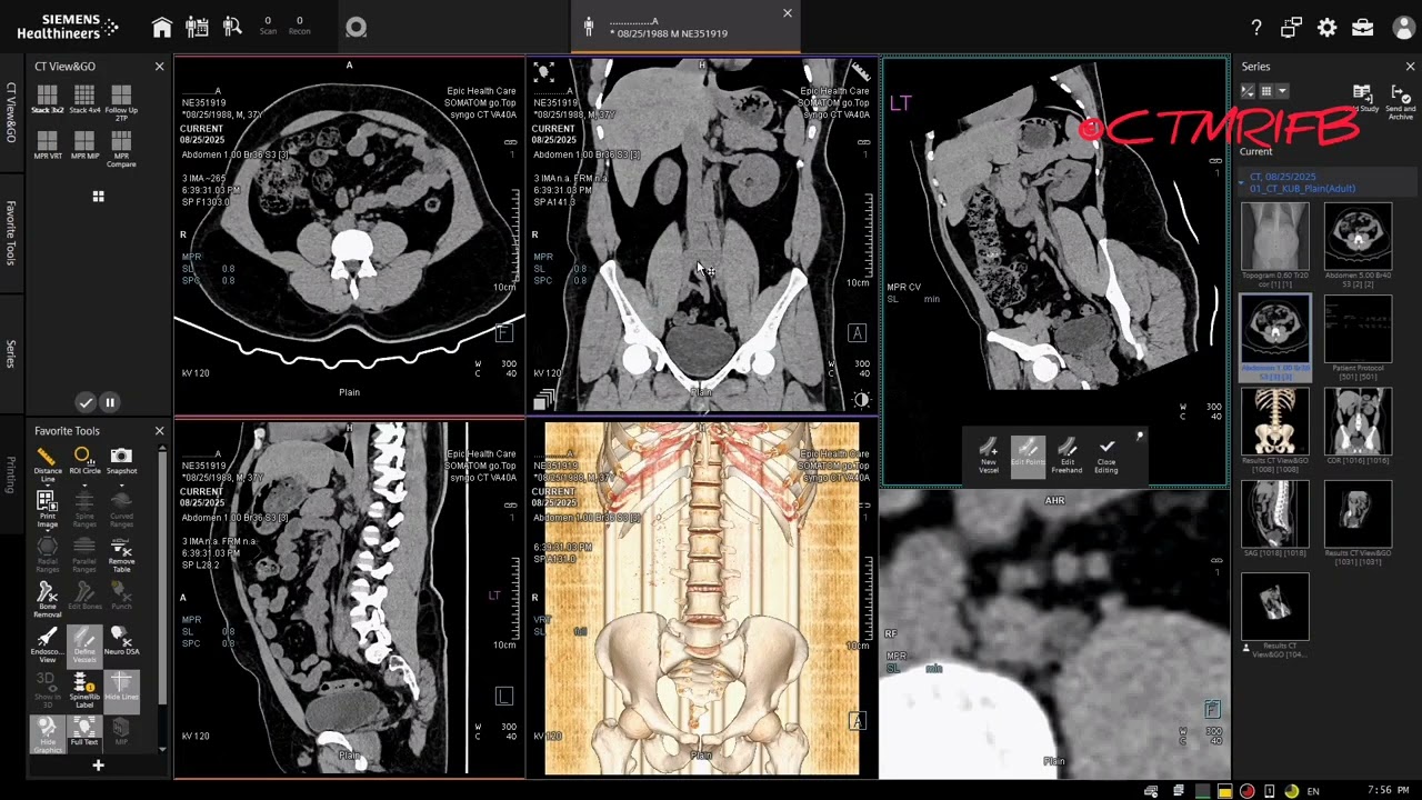 CT Scan Non-Contrast KUB Ureter Tracking #radiology #radiographer #CTscan #CTKUB #kidneydisease