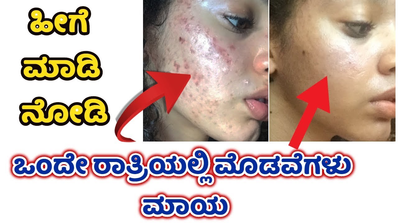 ಮೊಡವೆಗಳಿಗೆ ಪರಿಹಾರ ಒಂದೇ ದಿನದಲ್ಲಿ Pimple Treatment / Acne Treatment in one day shridevi vlogs Kannada