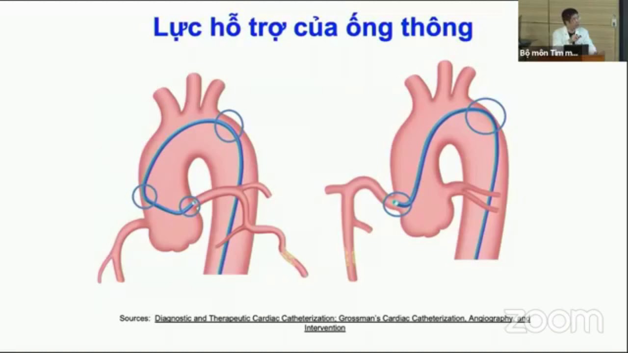 Dụng cụ và can thiệp động mạch vành cơ bản | TIM MẠCH CAN THIỆP (buổi 4)