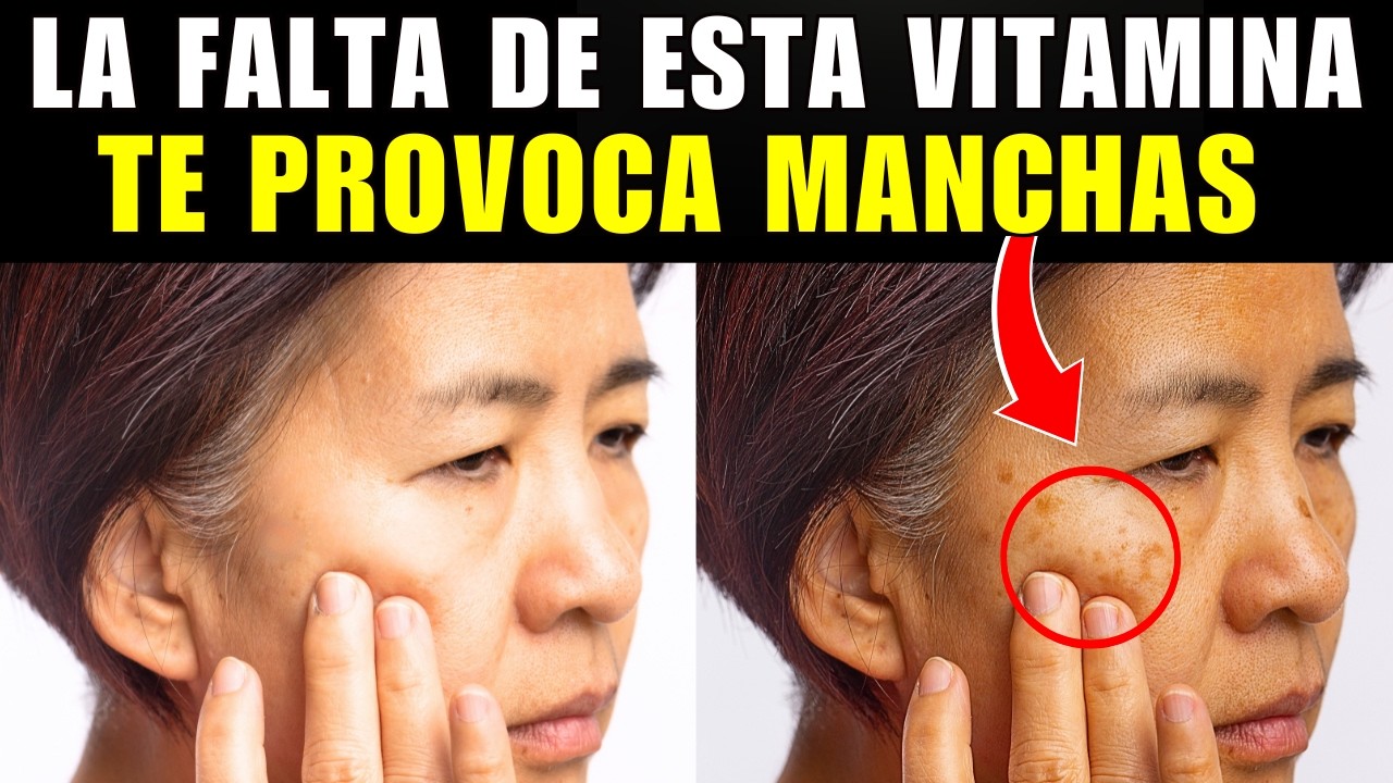 La VITAMINA #1 que ACLARA las MANCHAS &iexcl;Reduce el MELASMA!