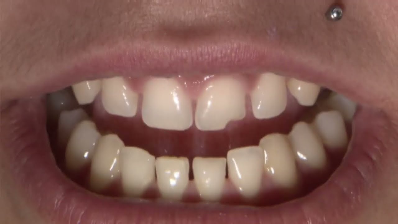 ANTERIOR #Dental Treatment Planning for #BruxZir Esthetic #4-#13