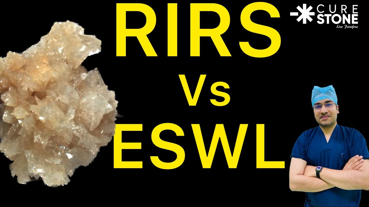 ESWL vs RIRS - फायदे - नुकसान | Which is Best Procedure for kidney stone RIRS or ESWL