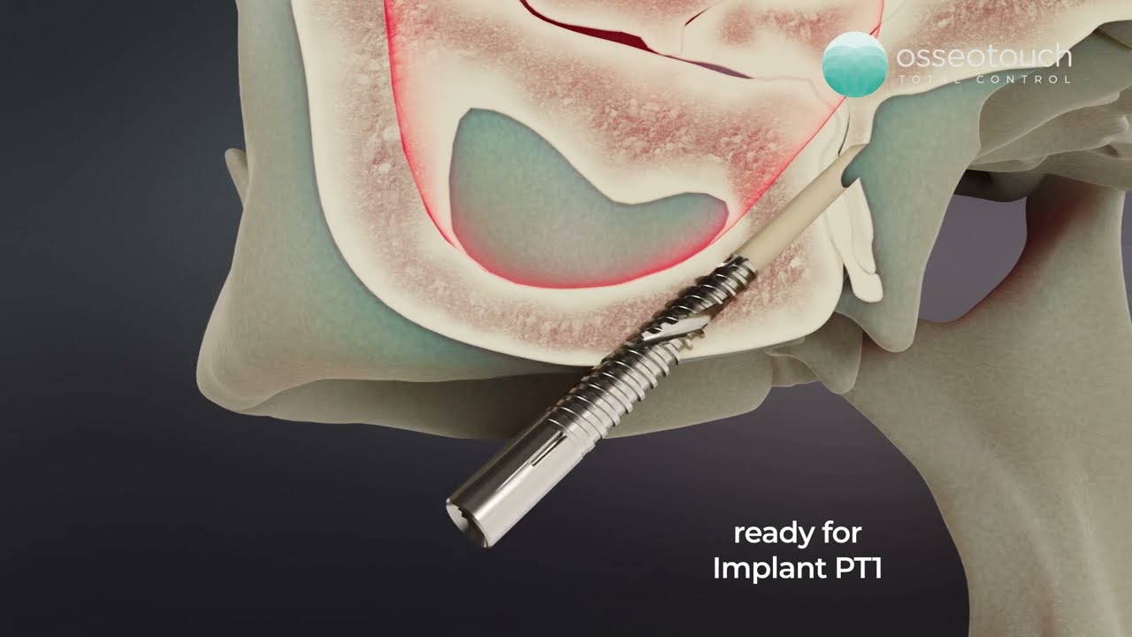 HOW placing Pterygoid implants with Magnetic Mallet