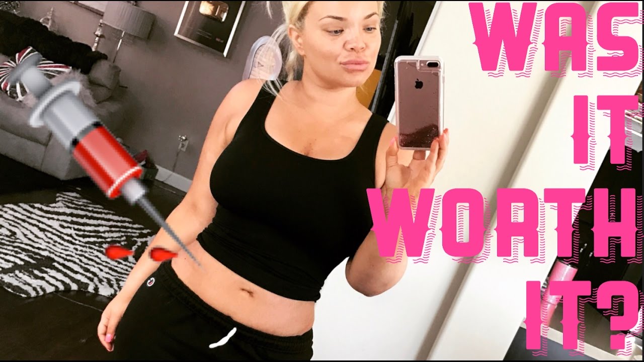 LIPOSUCTION UPDATE (FINAL RESULTS) - WEEK 6 POST OP