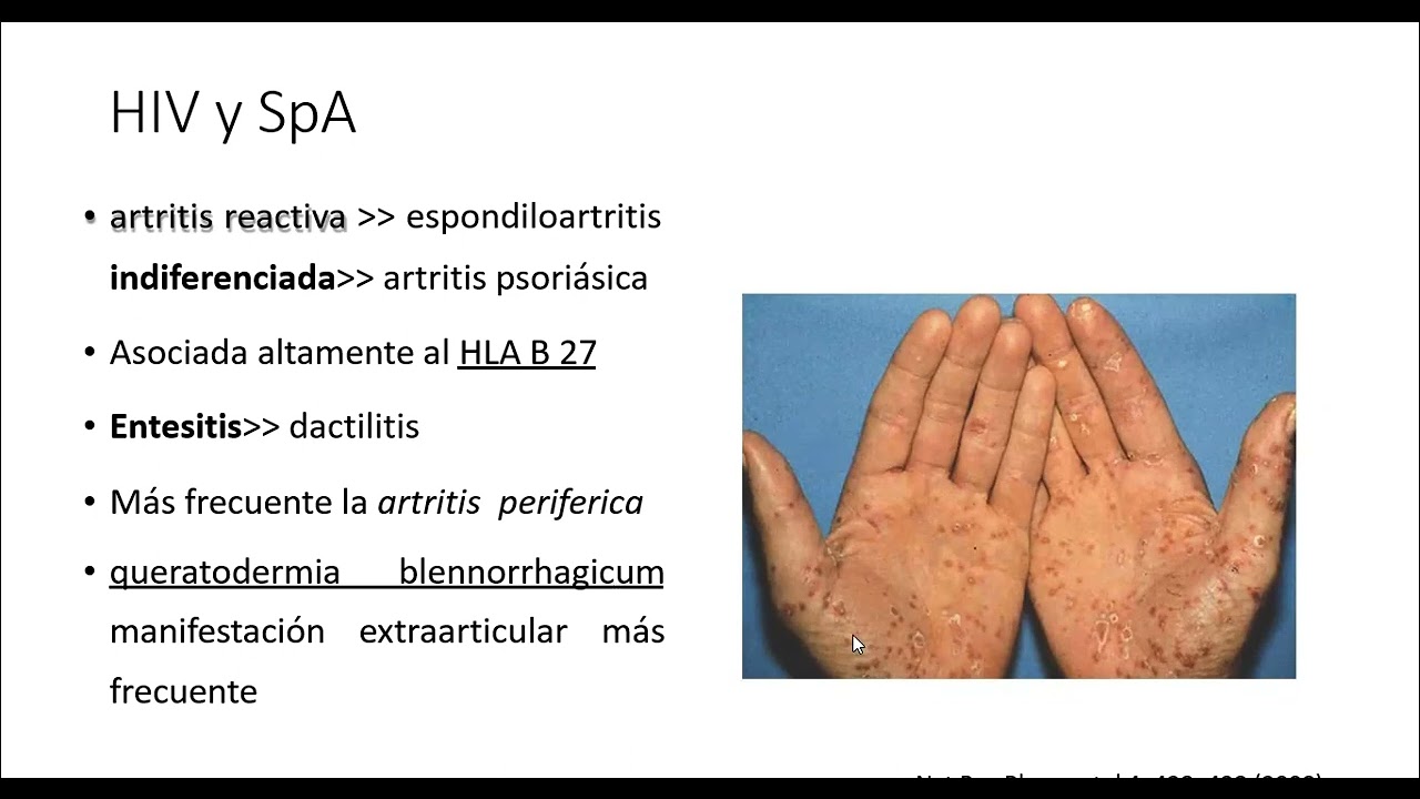 Artritis de origen viral