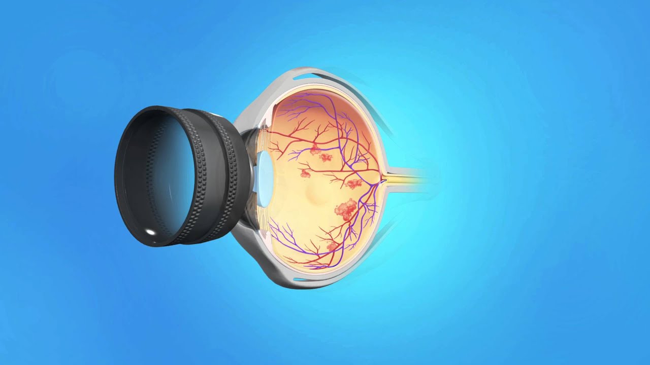 Proliferative Diabetic Retinopathy (PDR) Laser Photocoagulation