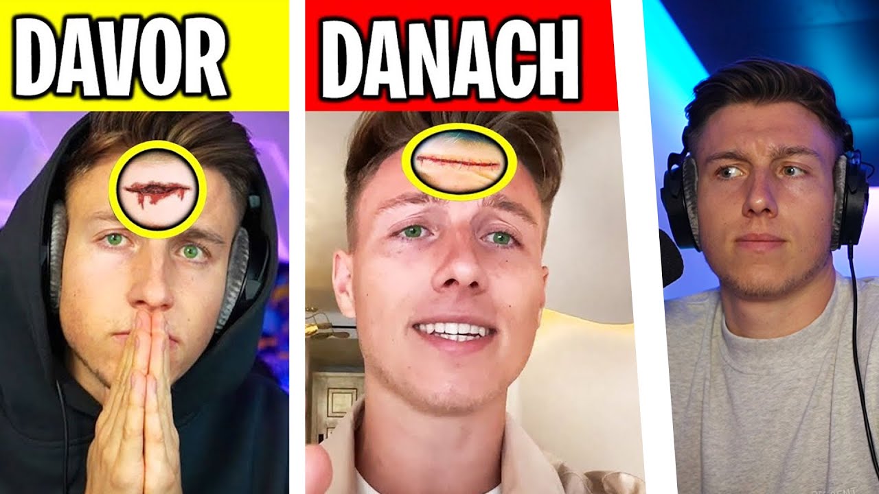 5 YOUTUBER die OPERIERT wurden (iCrimax, Avive,..)