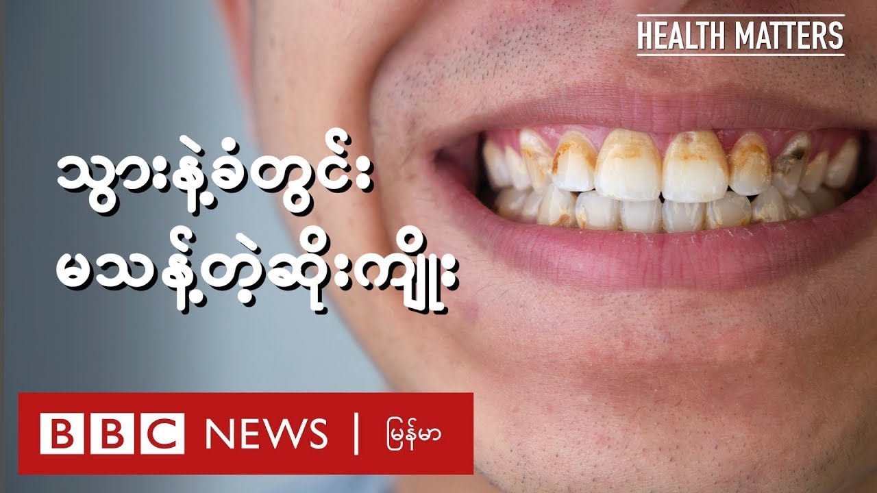 သွားနဲ့ခံတွင်း မသန့်တဲ့ဆိုးကျိုး - BBC News မြန်မာ