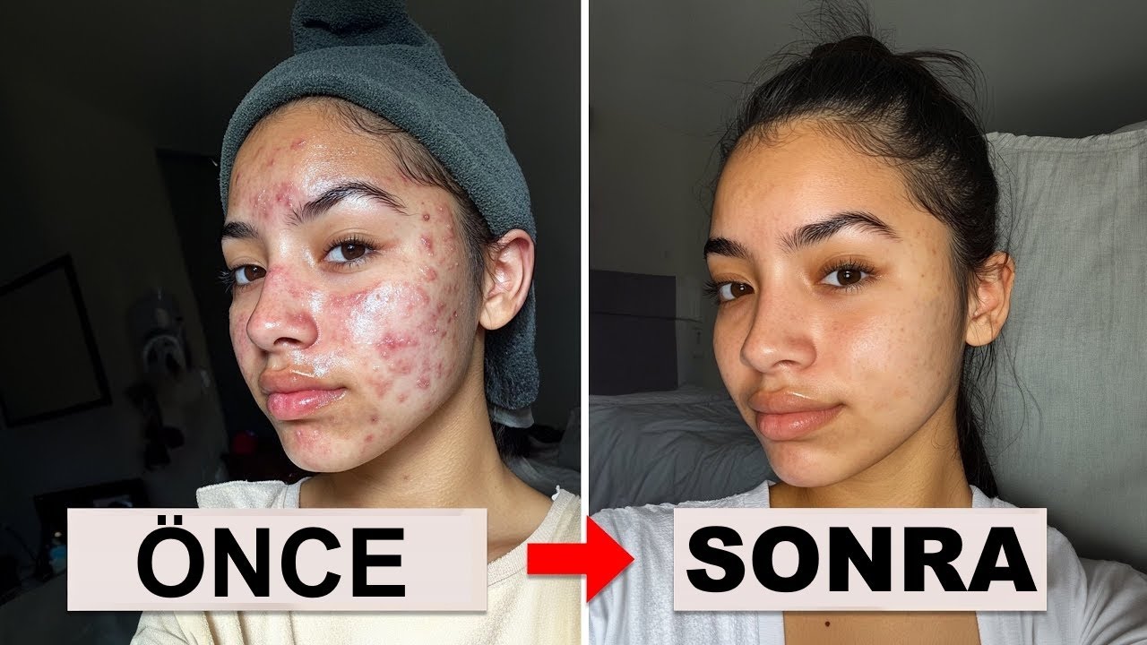 Sivilcelerden Kurtulmanın En Hızlı Yolu | Dr. Berg Türkçe