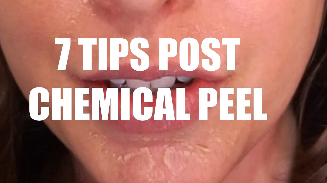 7 Tips for Post Chemical Peel Skincare of Skin Secrets by Dr. McLaren