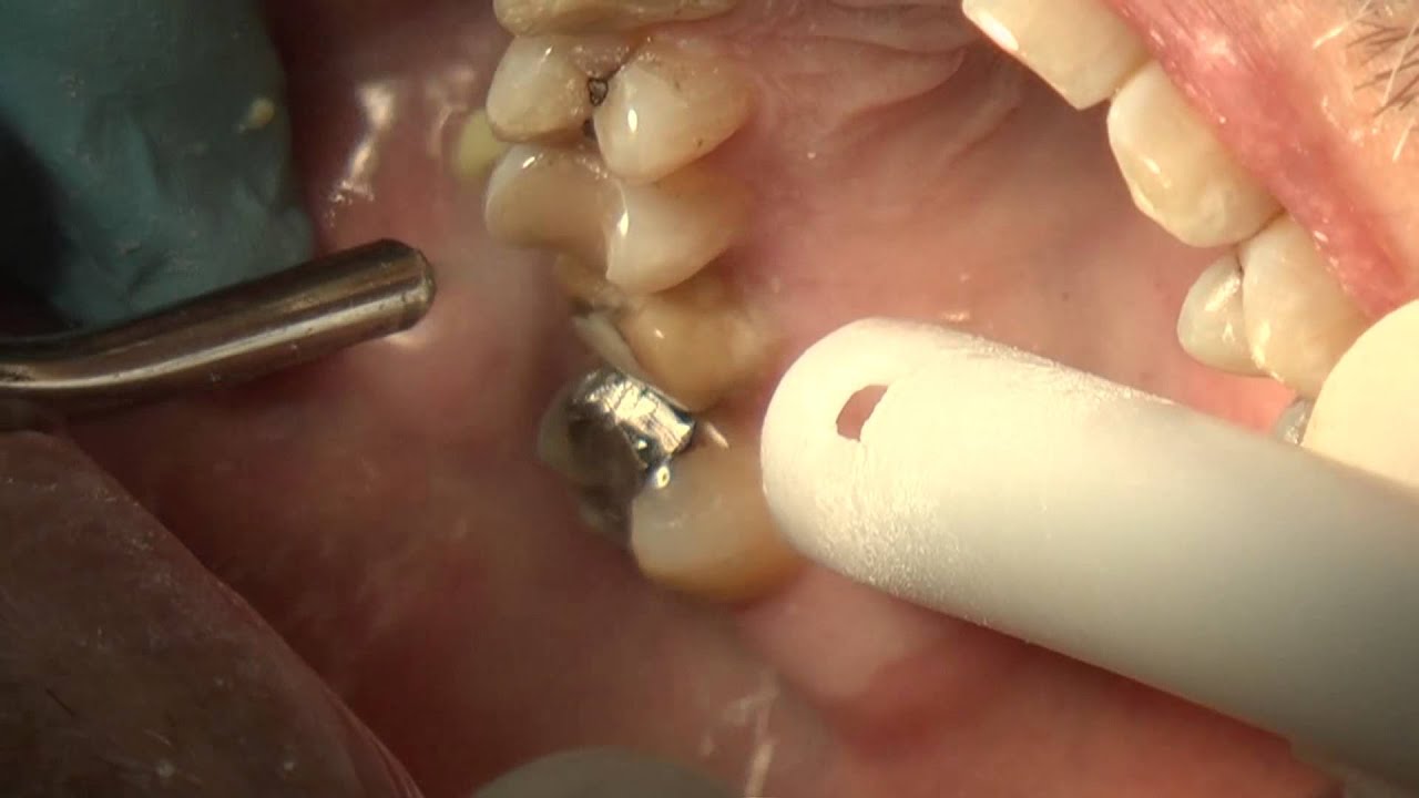 Premier CEREC Prep