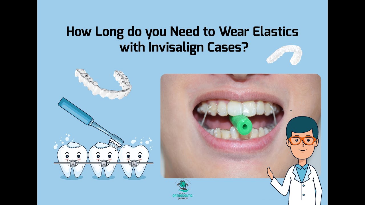 How Long do you Wear Elastics for with Invisalign?