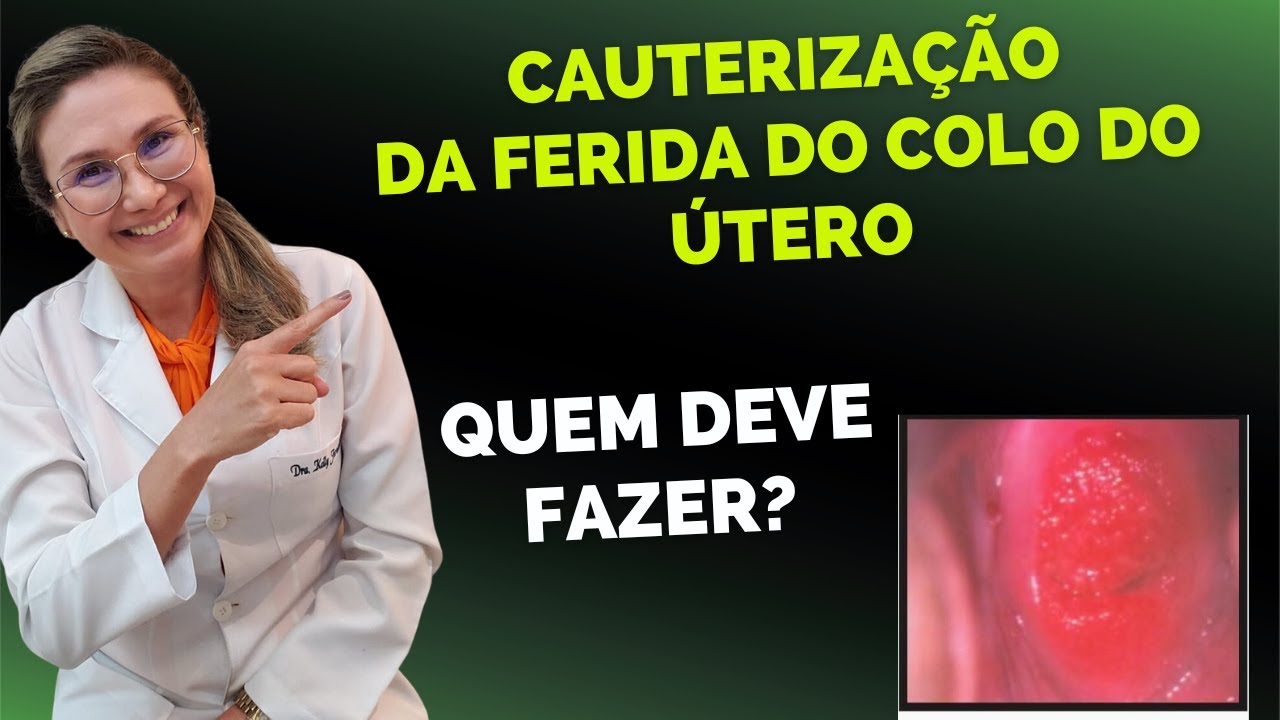 Cauterização da ectopia ou ferida no colo do útero, quando realizar?