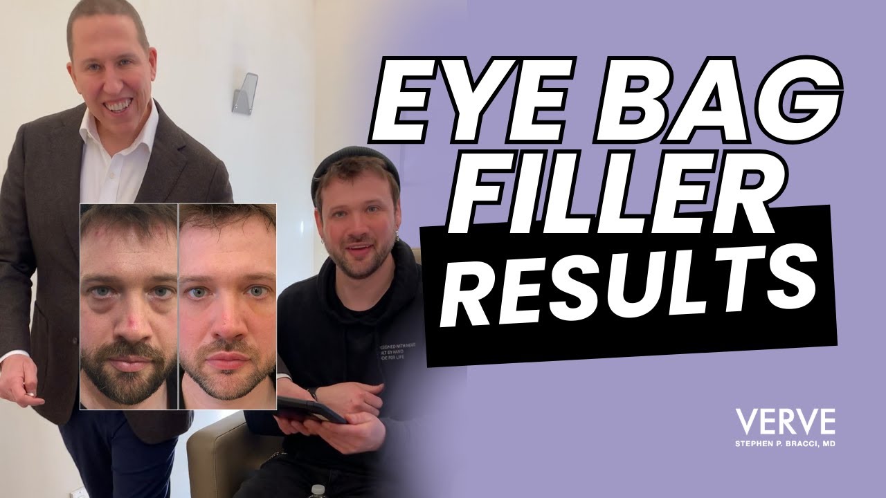 Transformative Under Eye Filler: Real Client Experience!