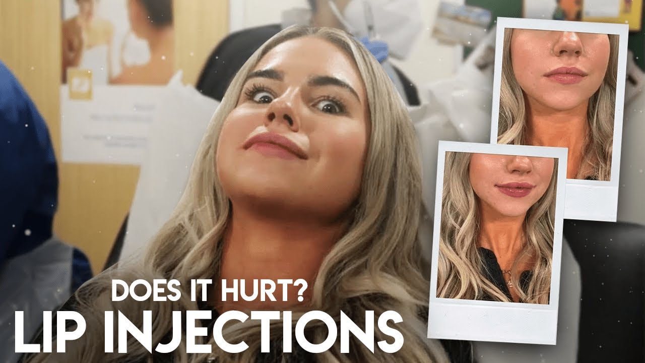 MY EXPERIENCE WITH LIP FILLERS | 0.55ml JUVEDERM | KEEPING UP WITH C