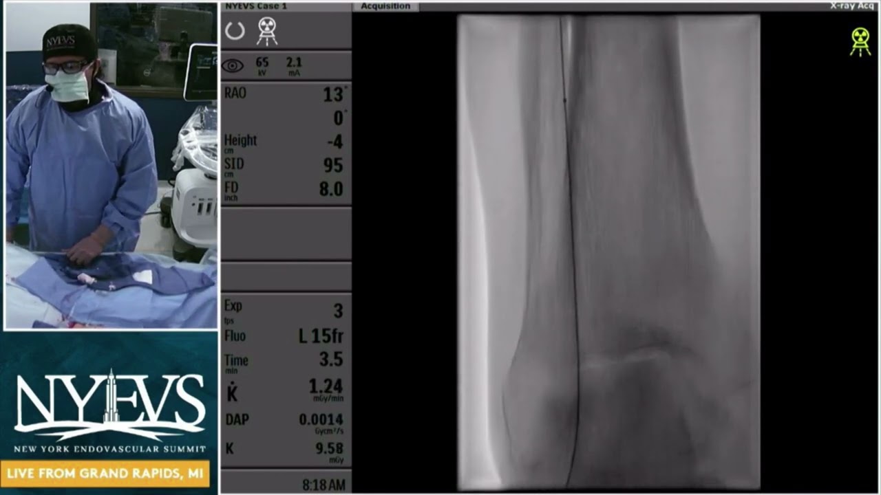 Live Case Presentation #1 Sessions In Clti Primary Pedal Access For Tibial Revascularization F  Saab
