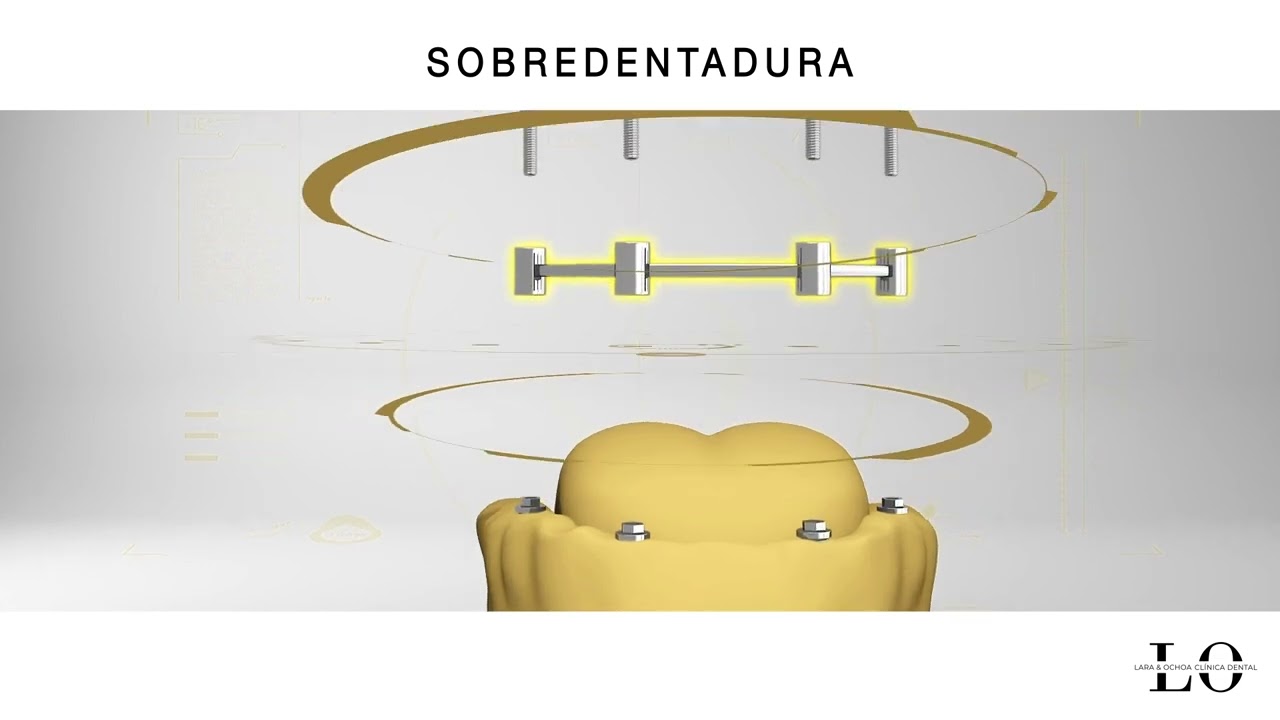 Implantes dentales en Logroño: sobredentadura