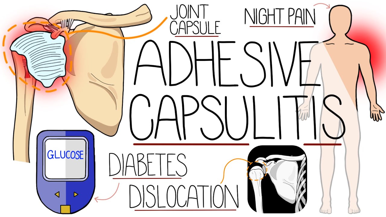 Adhesive Capsulitis (Frozen Shoulder Explained)