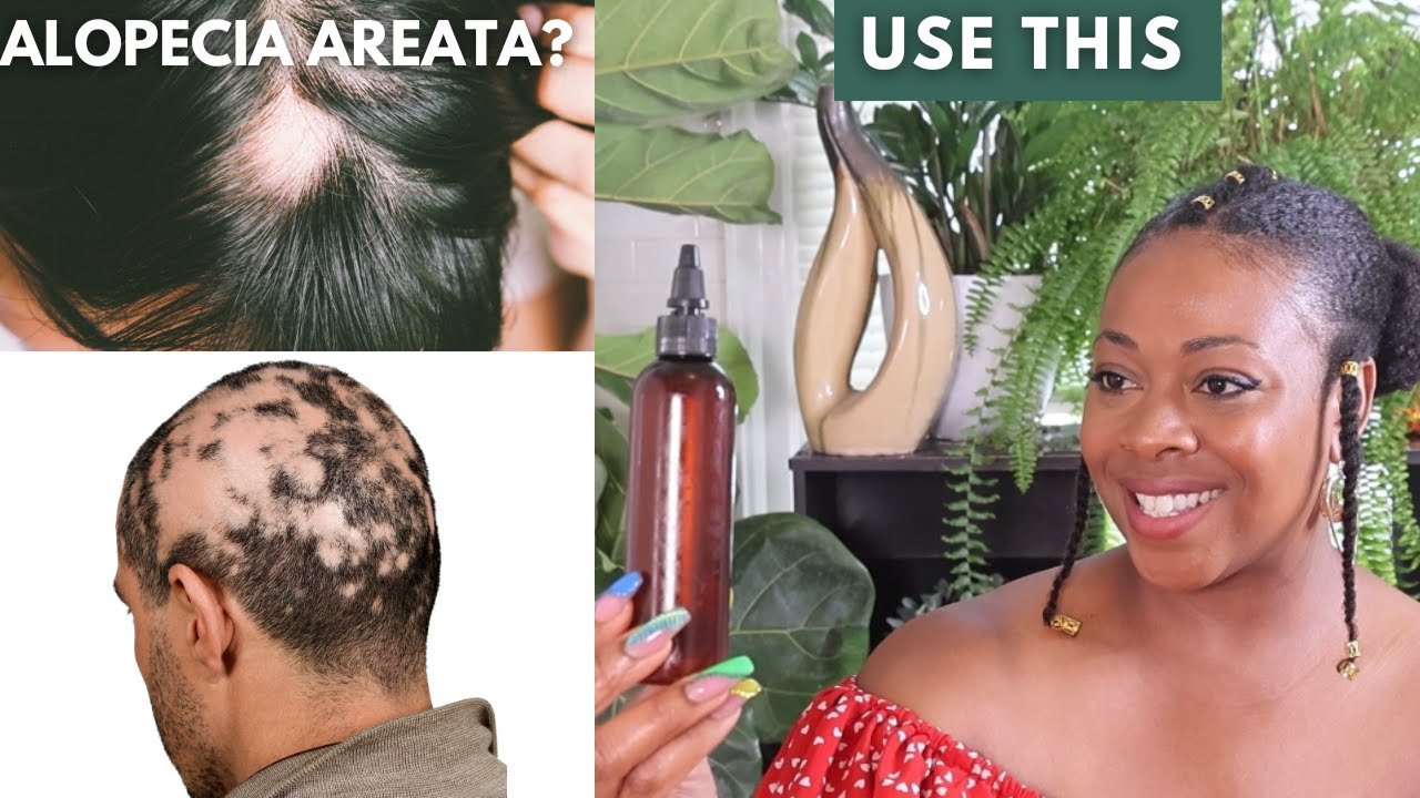 Fight Alopecia Areata & Androgenic Alopecia| Week 7 Prevent Hair Loss Challenge