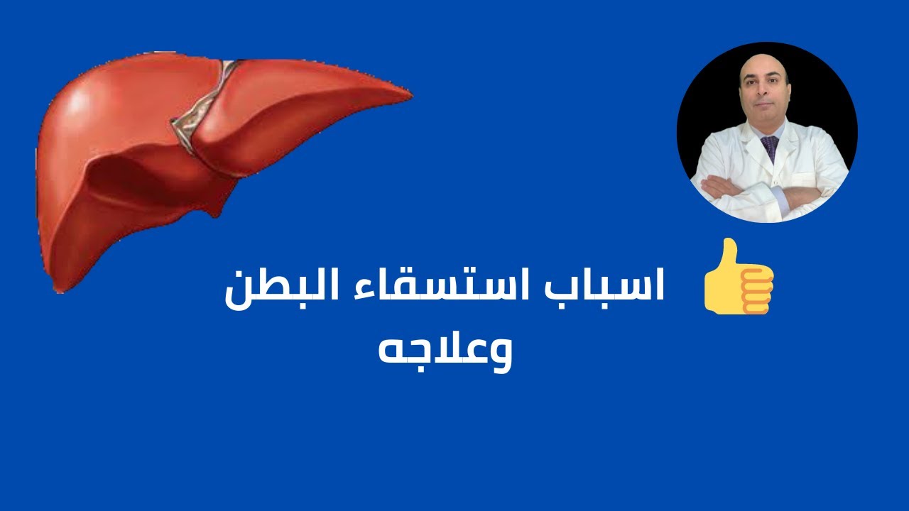 اعراض استسقاء البطن واسبابه و علاجه