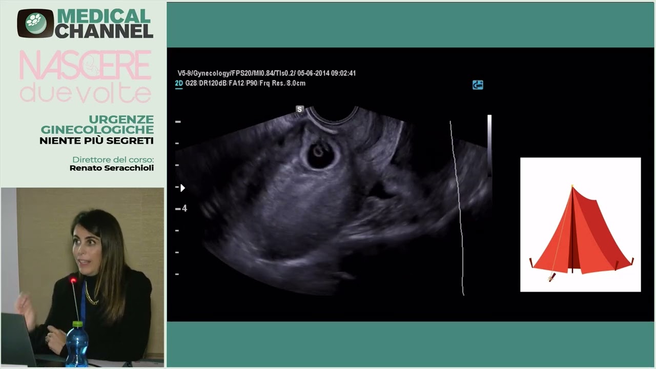 Scar pregnancy - L. De Meis