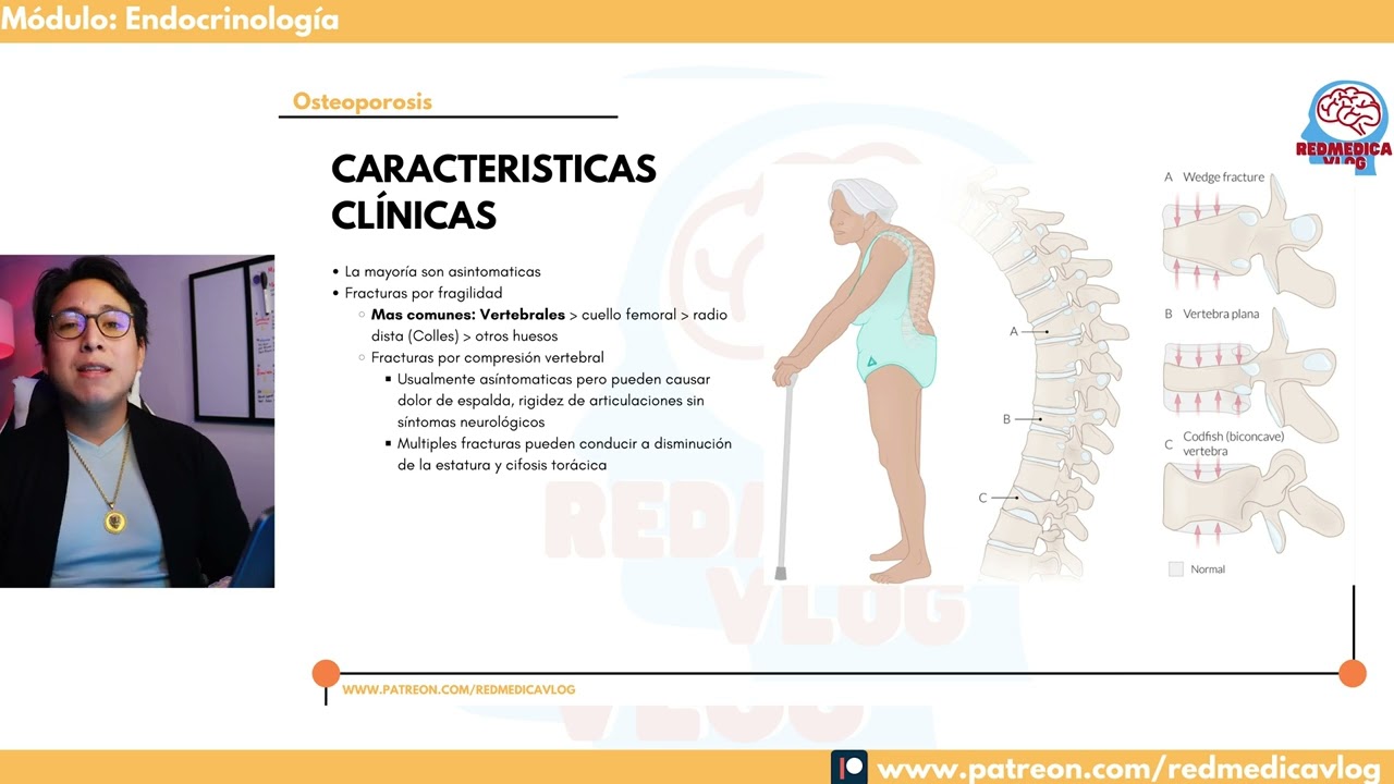 Osteoporosis #ENARM | 🩺Dr. Treviño