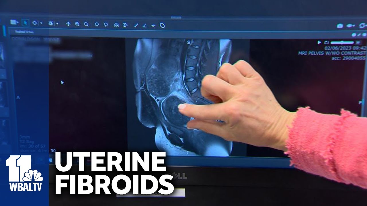 Jenyne Donaldson shares her experience with uterine fibroids to inspire women to get treatment