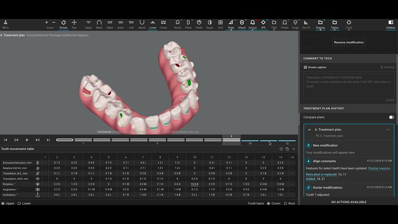 Invisalign Treatment Progress Evaluation - Deep Bite