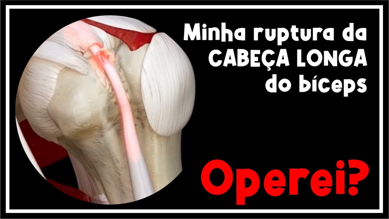Minha Ruptura da Cabeça Longa do Bíceps (Rotura Cabo Longo)