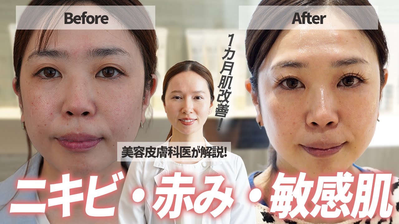 【ビフォアフ】40代女性が肌の1ヶ月間肌質改善スキンケア見直し！赤ら顔・大人ニキビ改善！