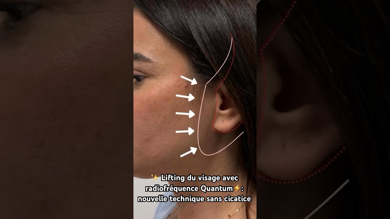 🔹Rel&acirc;chement cutan&eacute; du cou : que faire sans chirurgie lourde ? Le Dr Stroumza r&eacute;pond 👨🏻&zwj;⚕️
