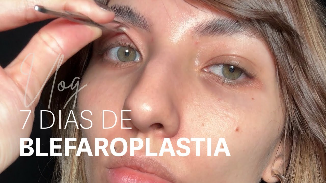 7 DIAS DE BLEFAROPLASTIA (Como foi minha recuperação?)